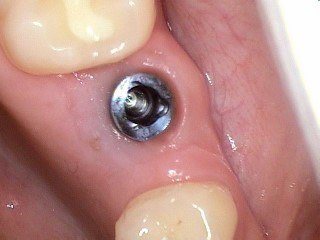 Before Implant