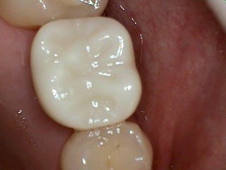 After Implant